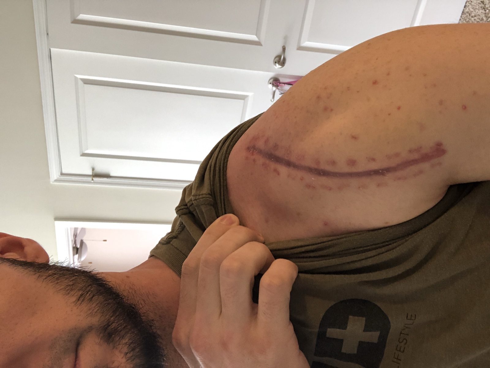 The lasting surgical scar across Andrew’s shoulder.
